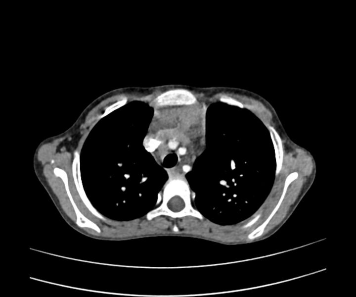File:Atrial septal defect complicated by Eisenmenger syndrome (Radiopaedia 53707-59768 Axial C+ CTPA 8).jpg