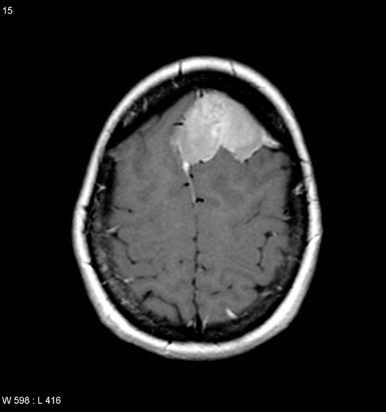 File:Atypical meningioma (WHO grade II) (Radiopaedia 7762-8586 D 11).jpg