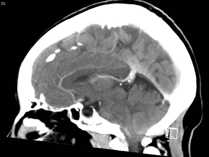 Atypical meningioma - intraosseous (Radiopaedia 64915-73867 F 34).jpg