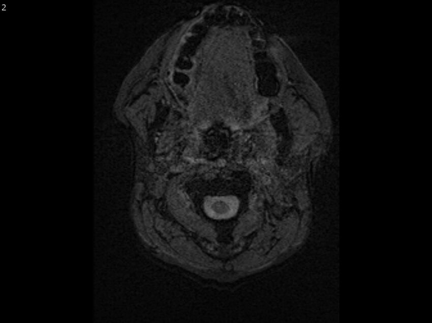 Atypical meningioma - intraosseous (Radiopaedia 64915-74572 Axial SWI 2).jpg
