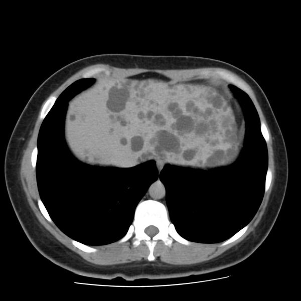 File:Autosomal dominant polycystic kidney disease (Radiopaedia 23061-23093 C+ delayed 8).jpg