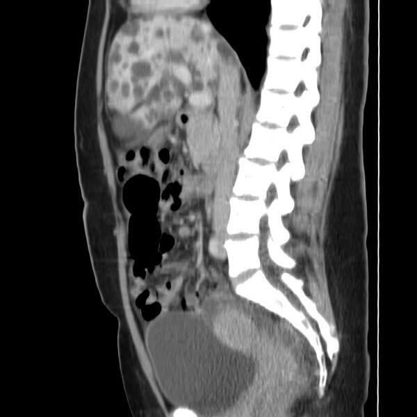 File:Autosomal dominant polycystic kidney disease (Radiopaedia 23061-23093 F 26).jpg