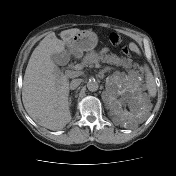 File:Autosomal dominant polycystic kidney disease (Radiopaedia 27851-28094 Axial non-contrast 61).jpg