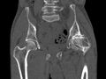 Avascular necrosis of the left hip (Radiopaedia 75068-86125 Coronal bone window 34).jpg