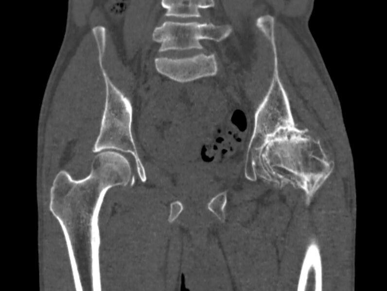 File:Avascular necrosis of the left hip (Radiopaedia 75068-86125 Coronal bone window 34).jpg