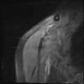 Avulsion fracture - greater tuberosity of humerus (Radiopaedia 71216-81515 Coronal PD fat sat 17).jpg