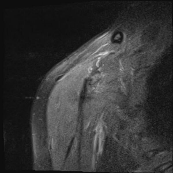 File:Avulsion fracture - greater tuberosity of humerus (Radiopaedia 71216-81515 Coronal PD fat sat 17).jpg