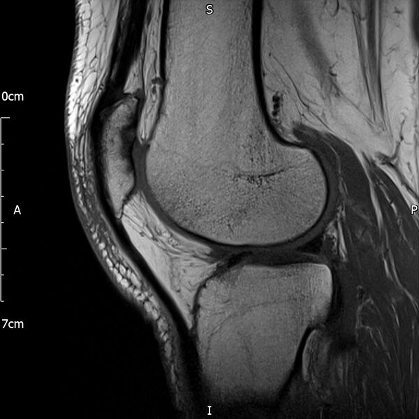 File:Avulsion fracture of the fibular head (Radiopaedia 74804-85808 D 22).jpg