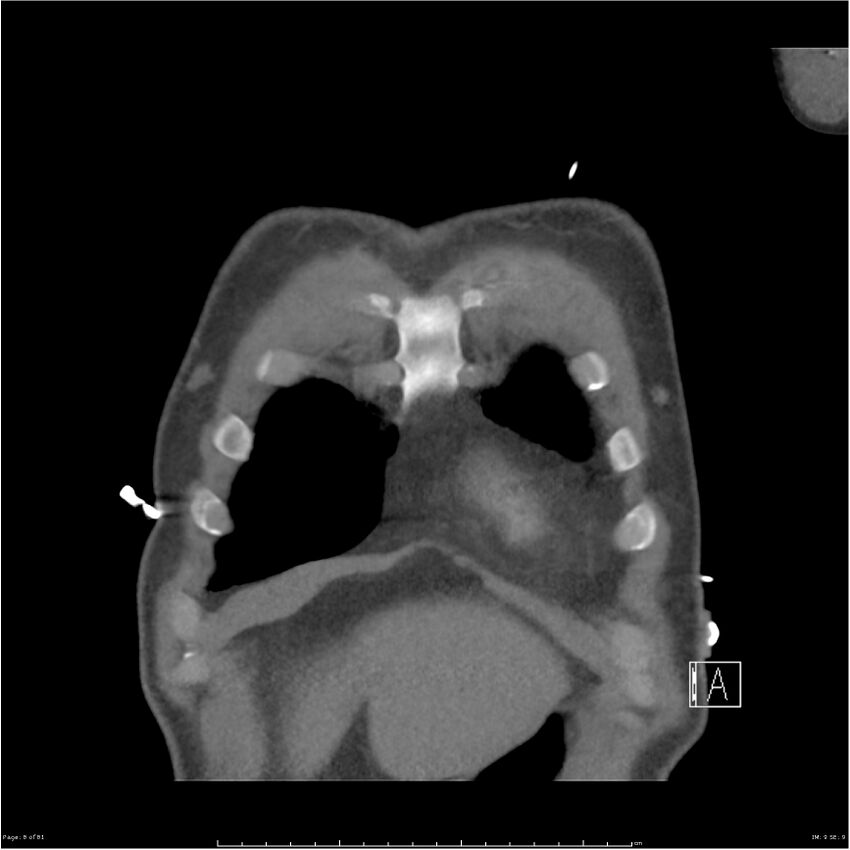 Azygos venous system anatomy (CT pulmonary angiography) (Radiopaedia 25928-26077 Coronal C+ CTPA 8).jpg