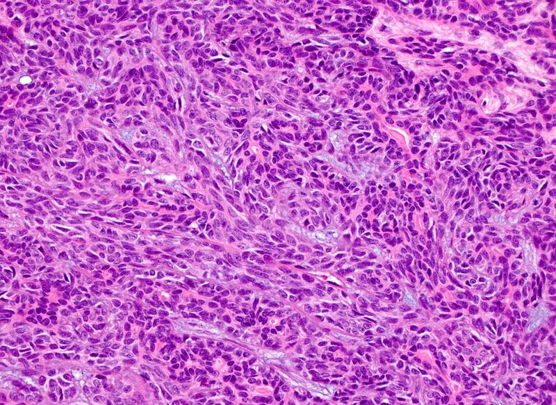 File:Basal cell adenoma - salivary gland (Radiopaedia 43989-47511 200x H&E 1).jpg
