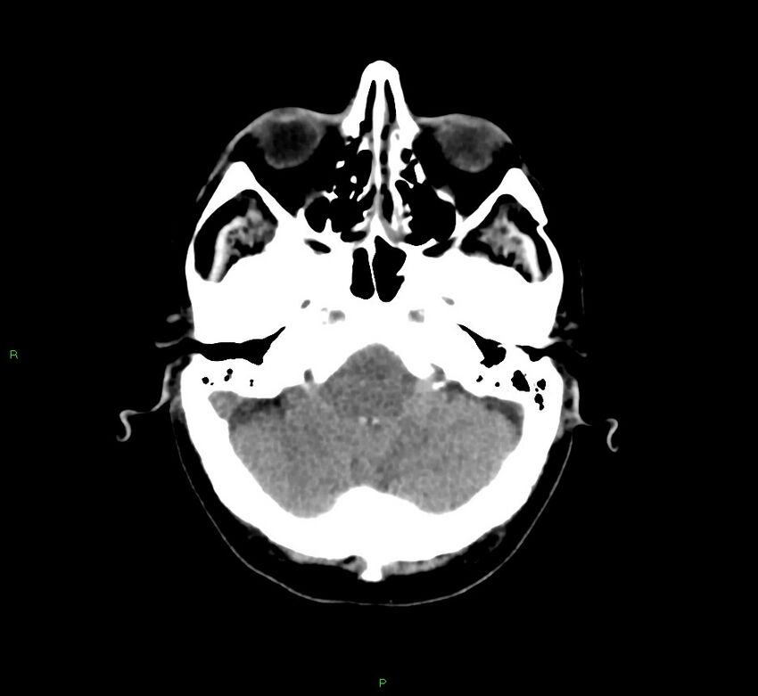 Basal ganglia hemorrhage (Radiopaedia 58775-66008 Axial non-contrast 47).jpg