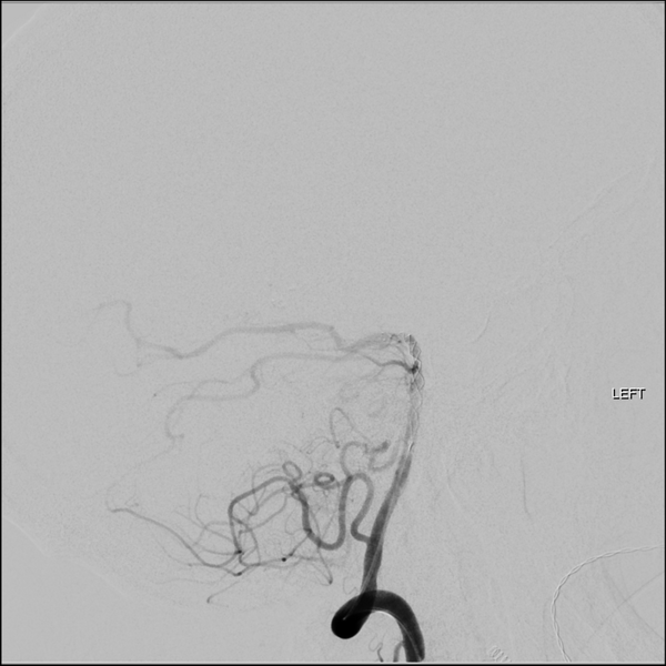 File:Basilar tip thrombus with endovascular clot retrieval (Radiopaedia 46320-50726 C 10).png