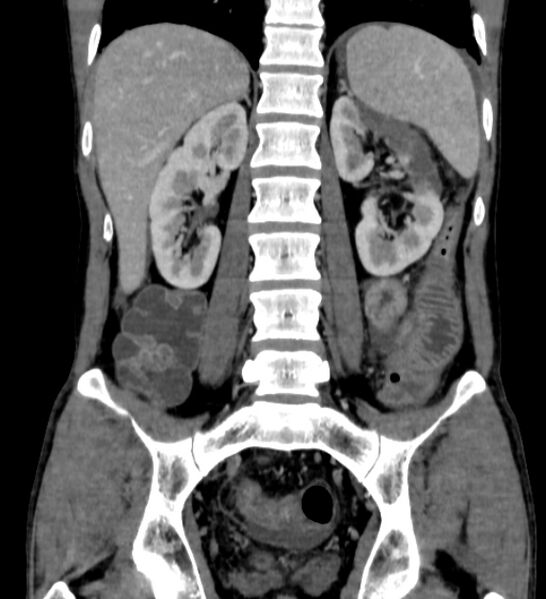 File:Behçet's disease- abdominal vasculitis (Radiopaedia 55955-62570 B 41).jpg