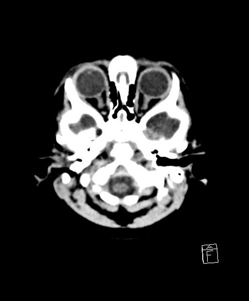File:Benign enlargement of subarachnoid spaces in infancy (BESS) (Radiopaedia 87459-103795 Axial non-contrast 78).jpg
