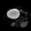Benign seromucinous cystadenoma of the ovary (Radiopaedia 71065-81300 T2 SPAIR 33).jpg