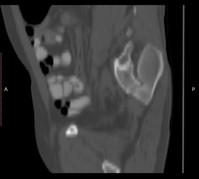 File:Bertolotti syndrome (Radiopaedia 58974-66235 Sagittal bone window 48).jpg