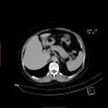 Bifid ureter (Radiopaedia 47604-52253 Axial C+ delayed 3).jpg