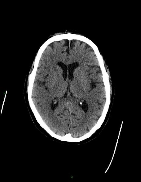 File:Bilateral acute middle cerebral artery territory infarcts (Radiopaedia 77319-89401 Axial non-contrast 45).jpg