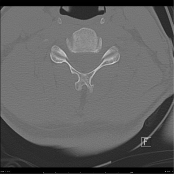 File:Bilateral cervical ribs (Radiopaedia 25868-26017 Axial bone window 28).jpg