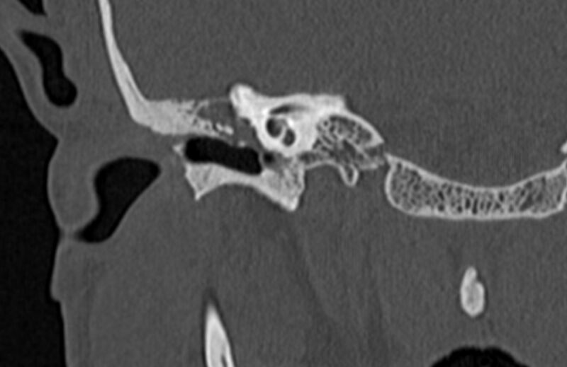File:Bilateral cholesteatoma (Radiopaedia 54898-61172 Coronal bone window 30).jpg