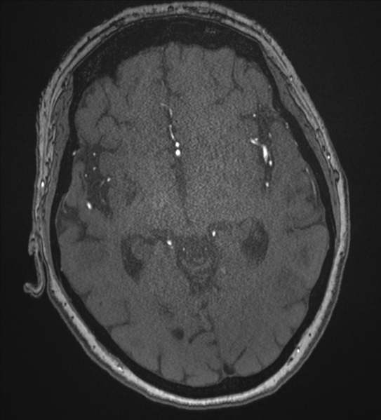 File:Bilateral fetal posterior communicating arteries (Radiopaedia 41286-44102 Axial MRA 99).png