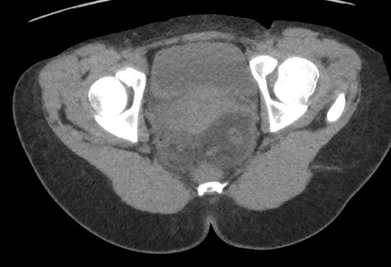 File:Bilateral mature cystic ovarian teratoma (Radiopaedia 88821-105592 Axial non-contrast 43).jpg