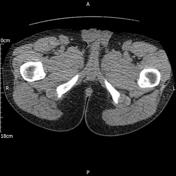 File:Bilateral medullary nephrocalcinosis with ureteric calculi (Radiopaedia 71269-81569 Axial non-contrast 149).jpg