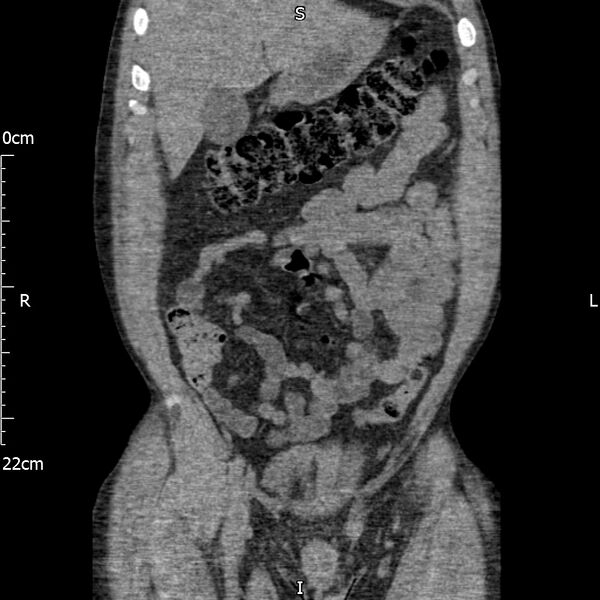 File:Bilateral medullary nephrocalcinosis with ureteric calculi (Radiopaedia 71269-81569 Coronal non-contrast 18).jpg