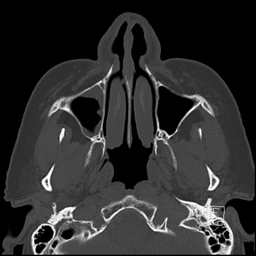 Bilateral palatine tonsilloliths on OPG and CT (Radiopaedia 75167-86247 Axial bone window 25).jpg