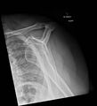 Bilateral shoulder injuries on chest x-ray (Radiopaedia 50809-56298 Lateral 1).jpg