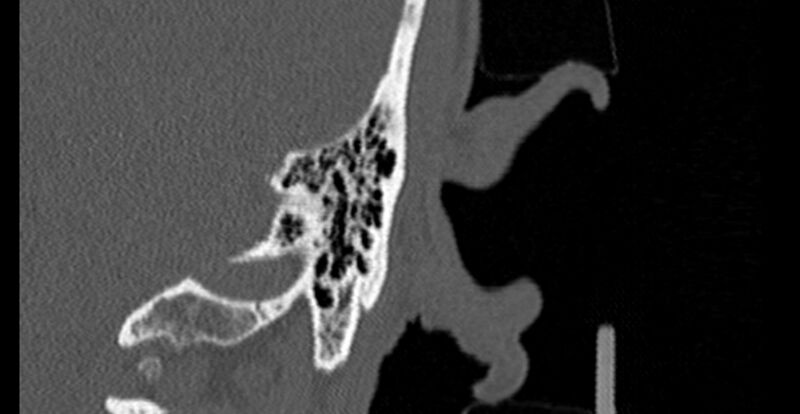 File:Bilateral temporal bone fractures (Radiopaedia 29482-29970 B 90).jpg