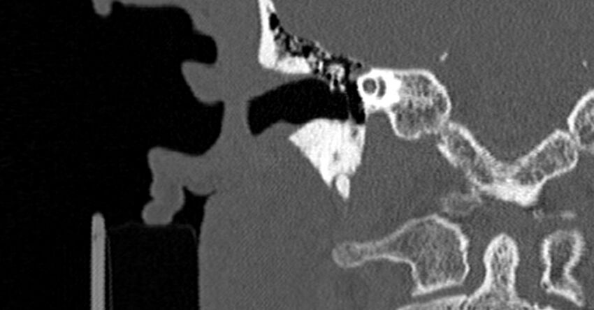 Bilateral temporal bone fractures (Radiopaedia 29482-29970 Coronal non-contrast 95).jpg