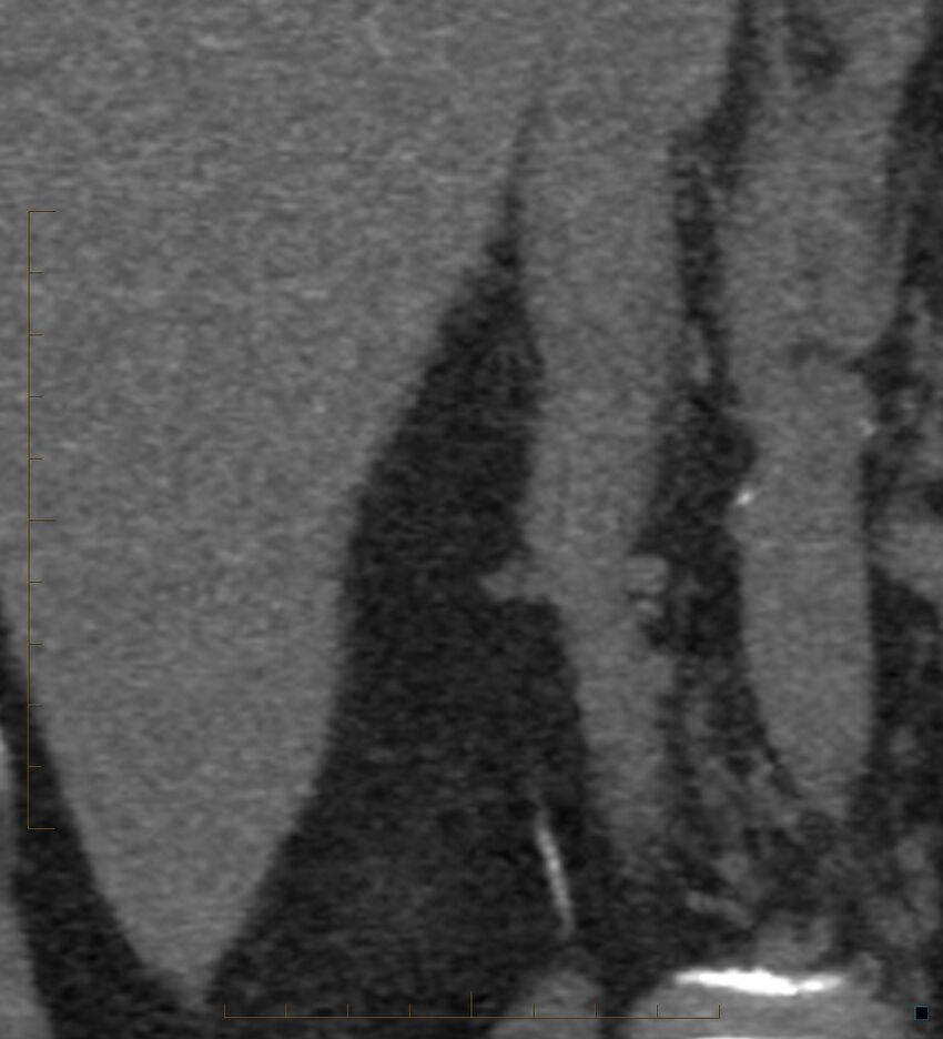 Bile leak from accessory duct(s) of Luschka post cholecystectomy (Radiopaedia 40736-43389 B 44).jpg