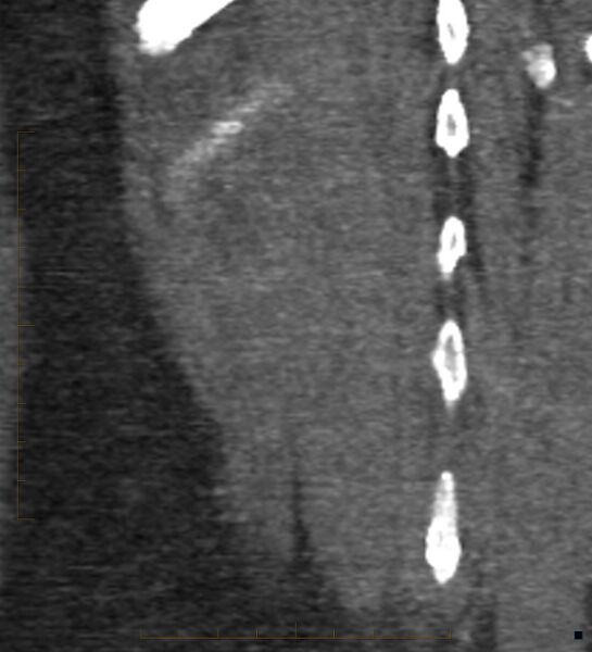 File:Bile leak from accessory duct(s) of Luschka post cholecystectomy (Radiopaedia 40736-43389 B 73).jpg