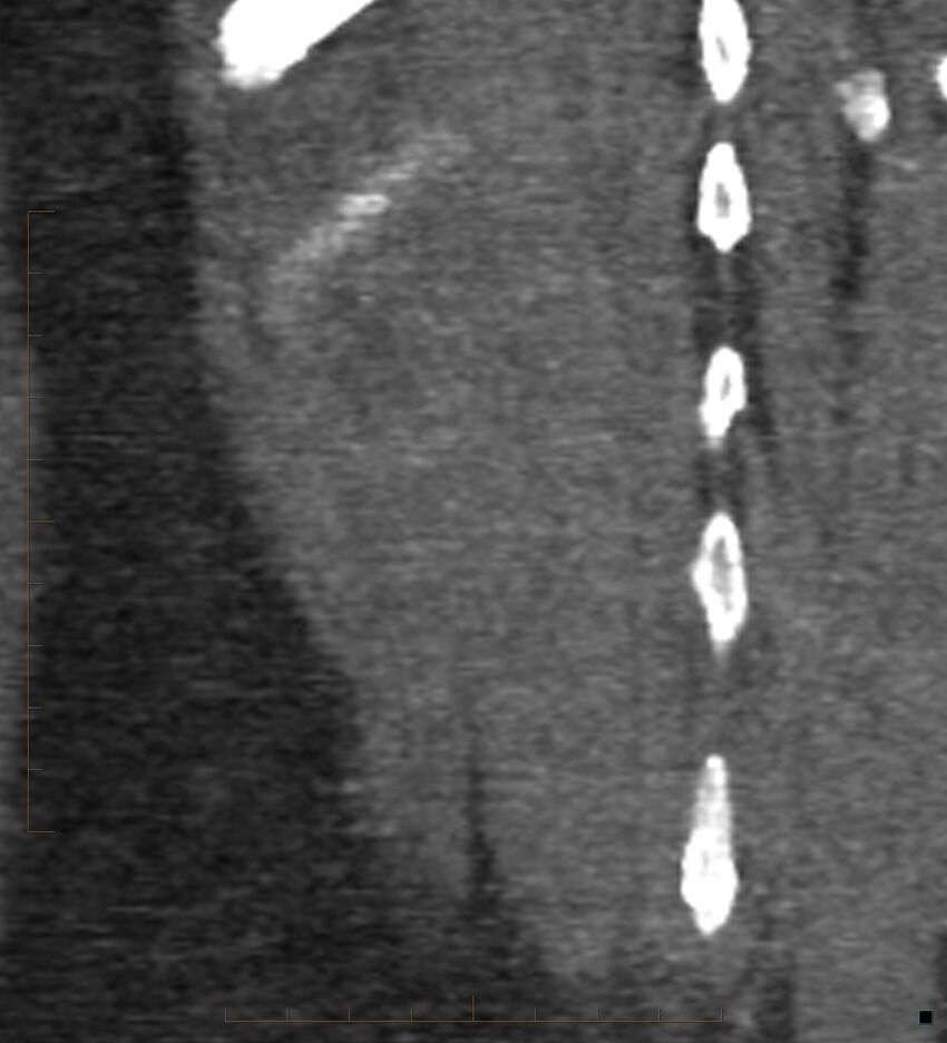 Bile leak from accessory duct(s) of Luschka post cholecystectomy (Radiopaedia 40736-43389 B 73).jpg