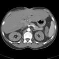 Biliary necrosis - liver transplant (Radiopaedia 21876-21845 A 19).jpg