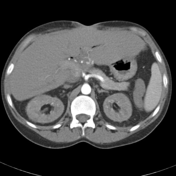 File:Biliary necrosis - liver transplant (Radiopaedia 21876-21845 A 19).jpg