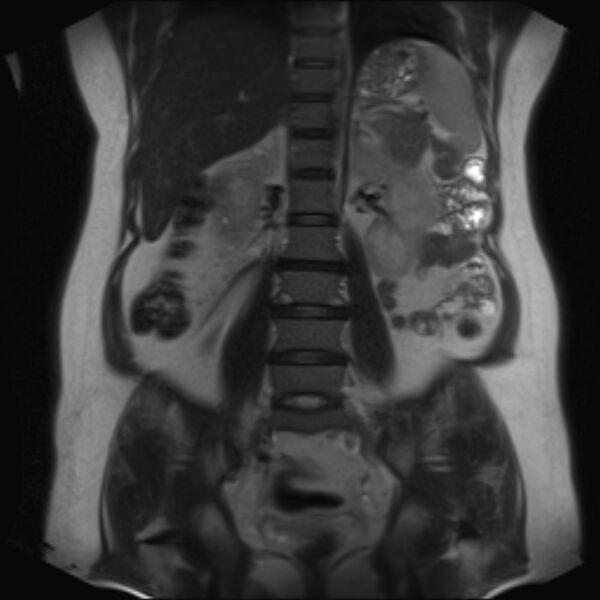 File:Bilobed placenta accreta (Radiopaedia 69648-79591 Coronal T2 26).jpg