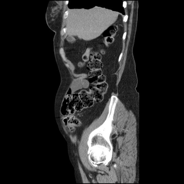 File:Bladder tumor detected on trauma CT (Radiopaedia 51809-57609 E 60).jpg