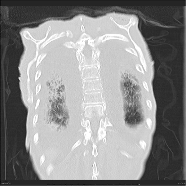 File:Boerhaave syndrome (Radiopaedia 26240-26362 Coronal lung window 30).jpg