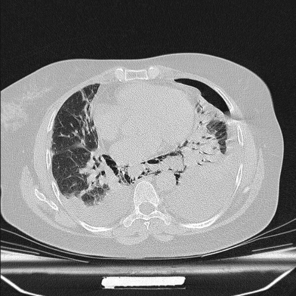 File:Boerhaave syndrome (Radiopaedia 45644-49799 Axial lung window 74).jpg