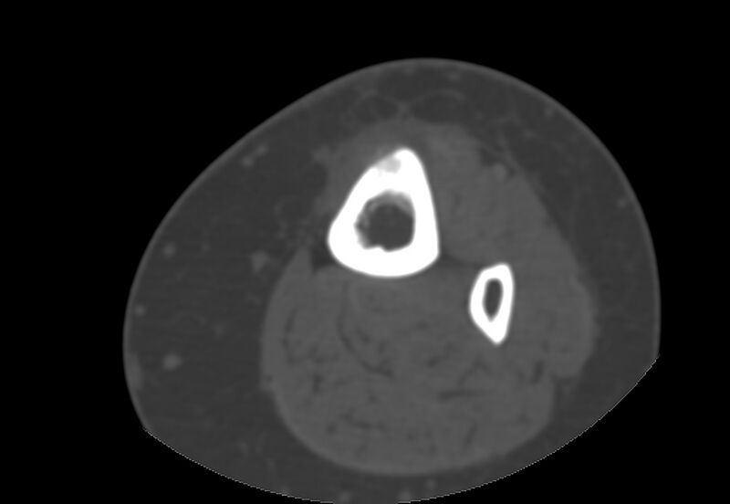 File:Bone metastasis - tibia (Radiopaedia 57665-64609 Axial bone window 21).jpg