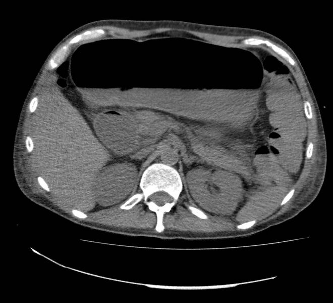 File:Bowel lymphoma complicated by bleeding after therapy (Radiopaedia 55601-62110 Axial non-contrast 25).jpg