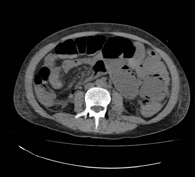 File:Bowel lymphoma complicated by bleeding after therapy (Radiopaedia 55601-62110 Axial non-contrast 44).jpg