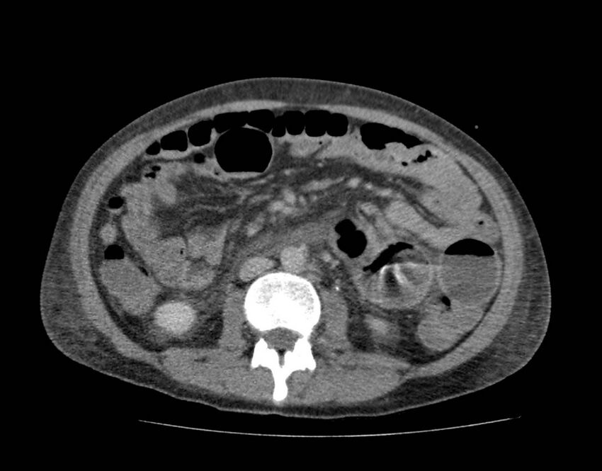 Bowel lymphoma complicated by bleeding after therapy (Radiopaedia 55601-62110 C 43).jpg