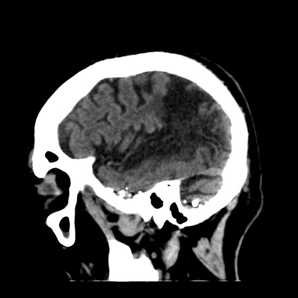 File:Brain Pantopaque remnants (Radiopaedia 78403-91048 C 13).jpg