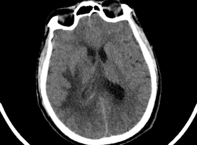 File:Brain abscess complicated by intraventricular rupture and ventriculitis (Radiopaedia 82434-96575 Axial non-contrast 50).jpg