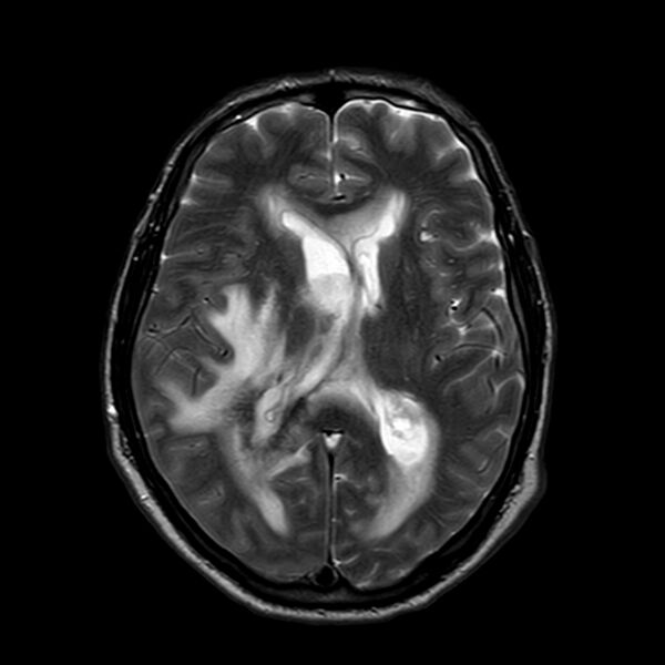 File:Brain abscess complicated by intraventricular rupture and ventriculitis (Radiopaedia 82434-96577 Axial T2 13).jpg