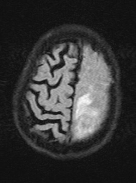 File:Brain abscess with dual rim sign (Radiopaedia 87566-103938 Axial FLAIR 20).jpg