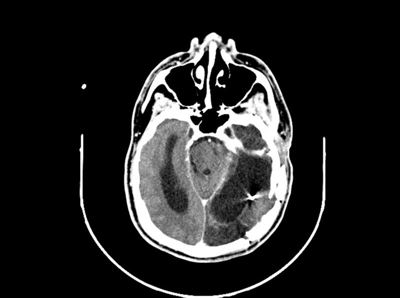 File:Brain injury by firearm projectile (Radiopaedia 82068-96088 B 103).jpg